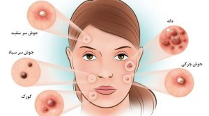 درمان جوش صورت در طب سنتی - علل جوش صورت - سالم بازار